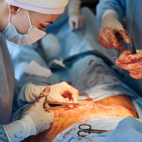 doctor-assistant-stitching-up-wound-after-abdominoplasty-surgery_651396-3086